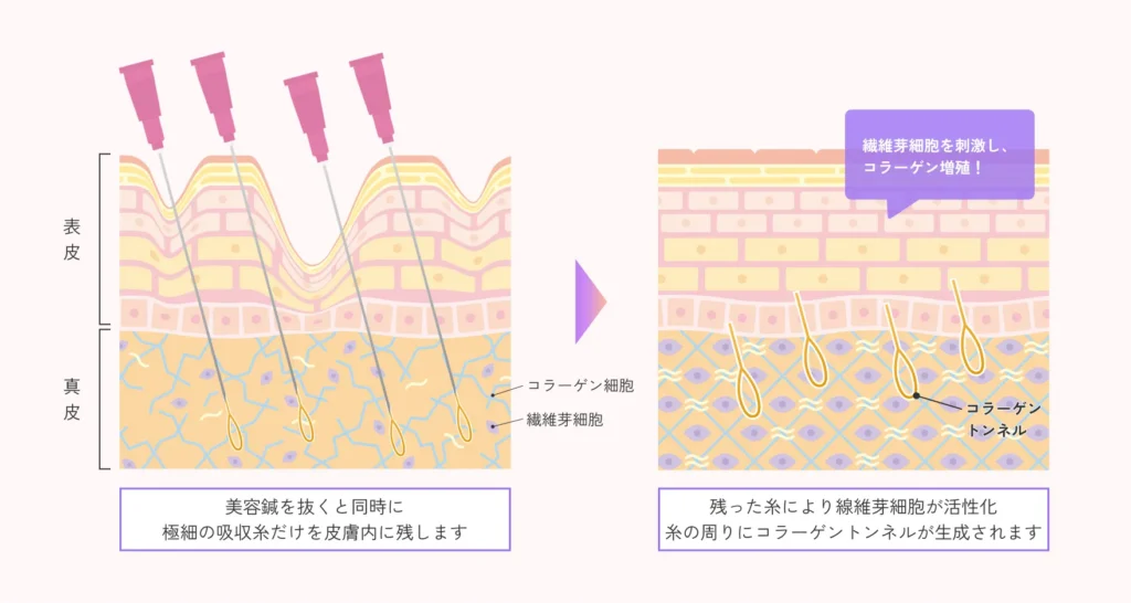 当院で使用するショッピングリフトのこだわり