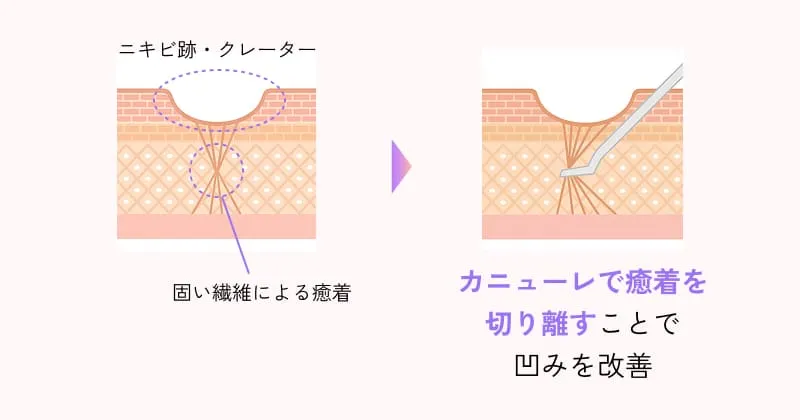 サブシジョンとは?