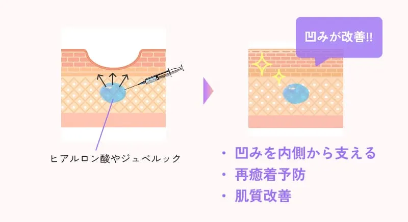ヒアルロン酸注入の重要性、ジュベルックに変更も可能