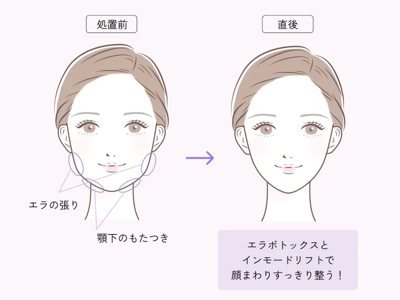 顔まわりすっきりセット(インモードリフト × エラボトックス)