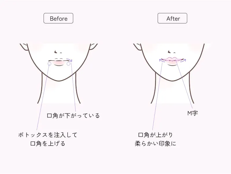 M字リップ形成セット（唇ヒアルロン酸 × 口角ボトックス）