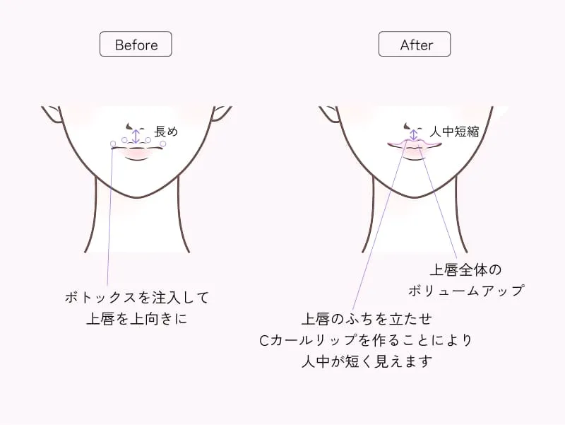 人中短縮セット（唇ヒアルロン酸 × 人中ボトックス）