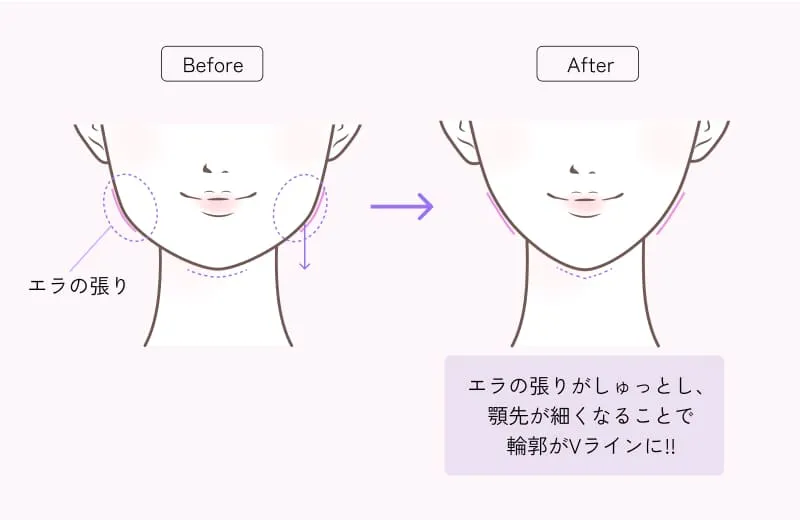 Vライン形成セット（顎ヒアルロン酸 × エラボトックス）
