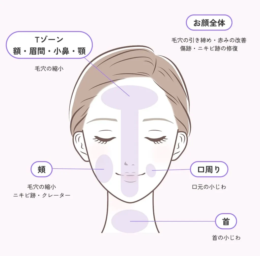 ジュベルックの適用部位